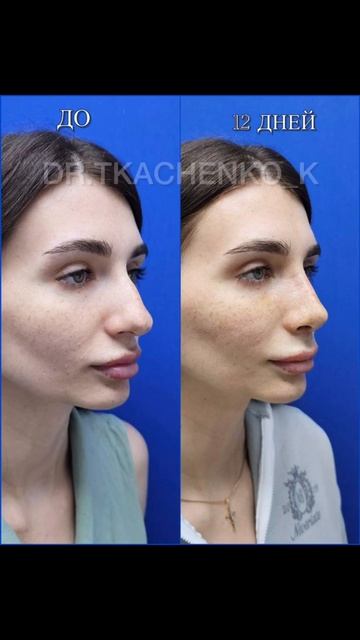 Результат риносептопластики спустя 12 дней. Только что сняли гипс.