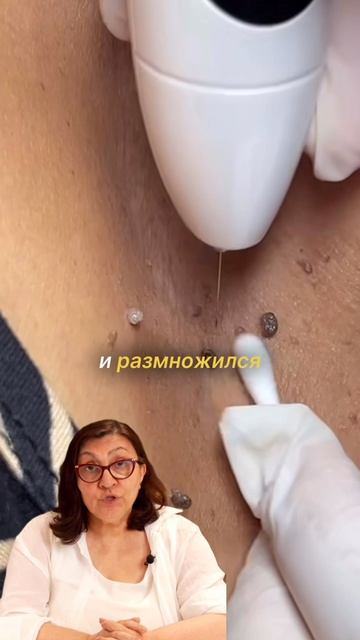 Папиломы — это не просто косметика. Вот что важно знать перед удалением