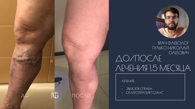 Во время лечения варикоза случилось чудо! Быстрый результат опытного флеболога из Тюмени