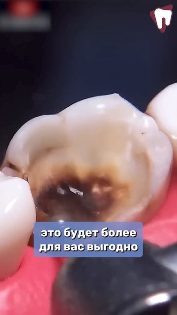 Когда лучше лечить зубы?#кариес #лечениекариеса  #стоматолог #стоматология #зубы #здоровыезубы
