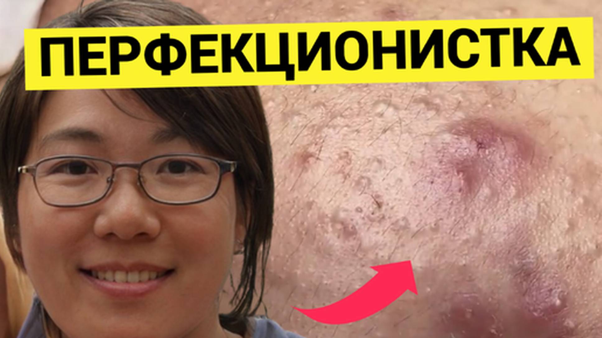ПЕРФЕКЦИОНИСТКА Чистит Кожу от Жировиков и Комедонов. На Работу Как На Праздник