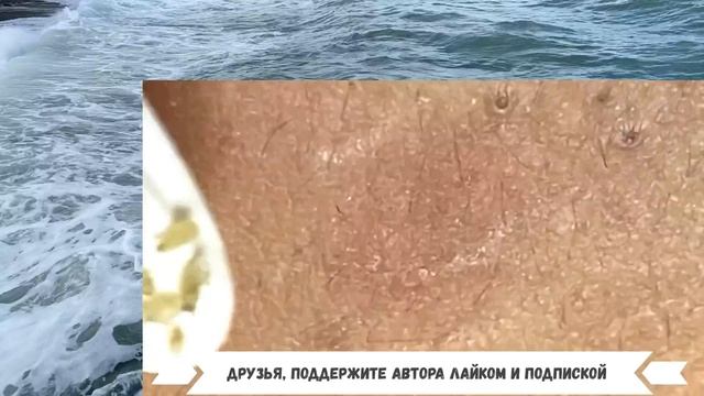 Очистка спины от Угрей и Жировиков. Мастер был неряшлив и допустил много ошибок(1)