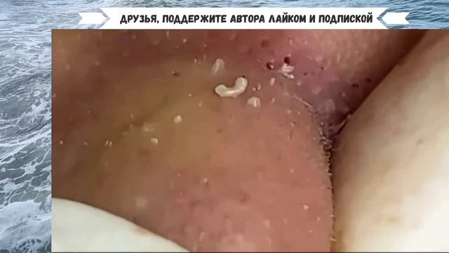 Микс Выдавливания Угрей и Прыщей очень Зрелищный. Косметологи не подвели и развлекли