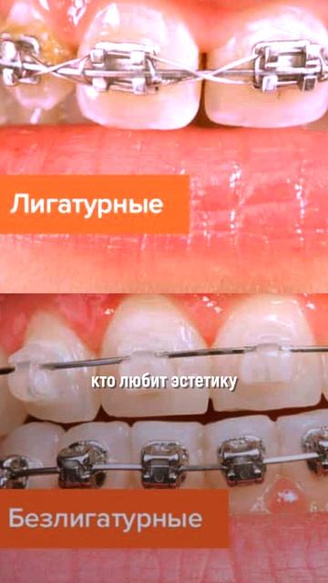 Системы брекетов