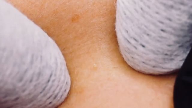 Очистка лица от угрей и акне.
Выдавливание прыщей. Удаление черных точек и комедонов.
