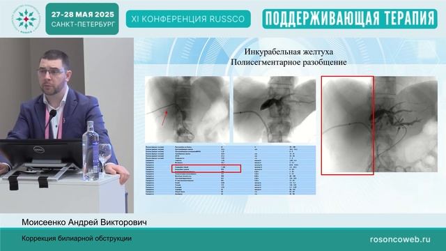 Коррекция билиарной обструкции