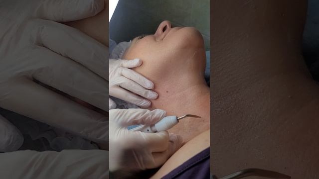Удаление папиллом. Метод электрокоагуляции