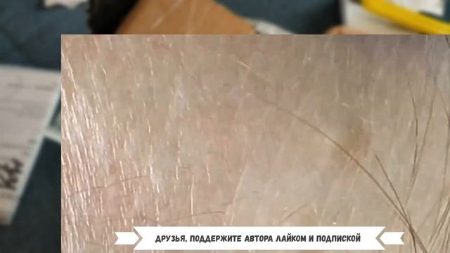 Желтые как КУКУРУЗА Комедоны и Жировики Пришлось Выдавливать Мастеру не без Труда. Зачем так тянула