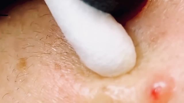 Механическая чистка лица