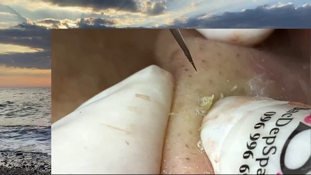 Пугливый Юноша с Комедонами и Черными Точками под Веком. Грубая, но эффективная работа мастера