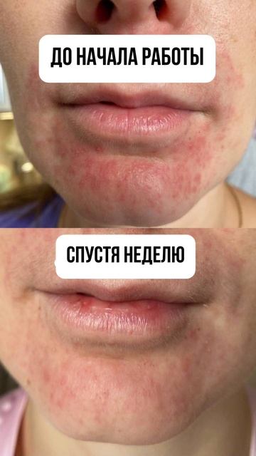 Переходи в актуальное ДЕРМАТИТ, если тебе знакома эта проблема, по ссылке шапке профиля в тг канал