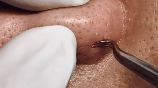 Механическая чистка лица