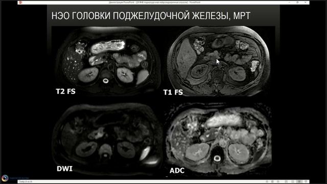ЛД в онкологии. Часть 1 7. Лекция «Рак поджелудочной железы.(2)
