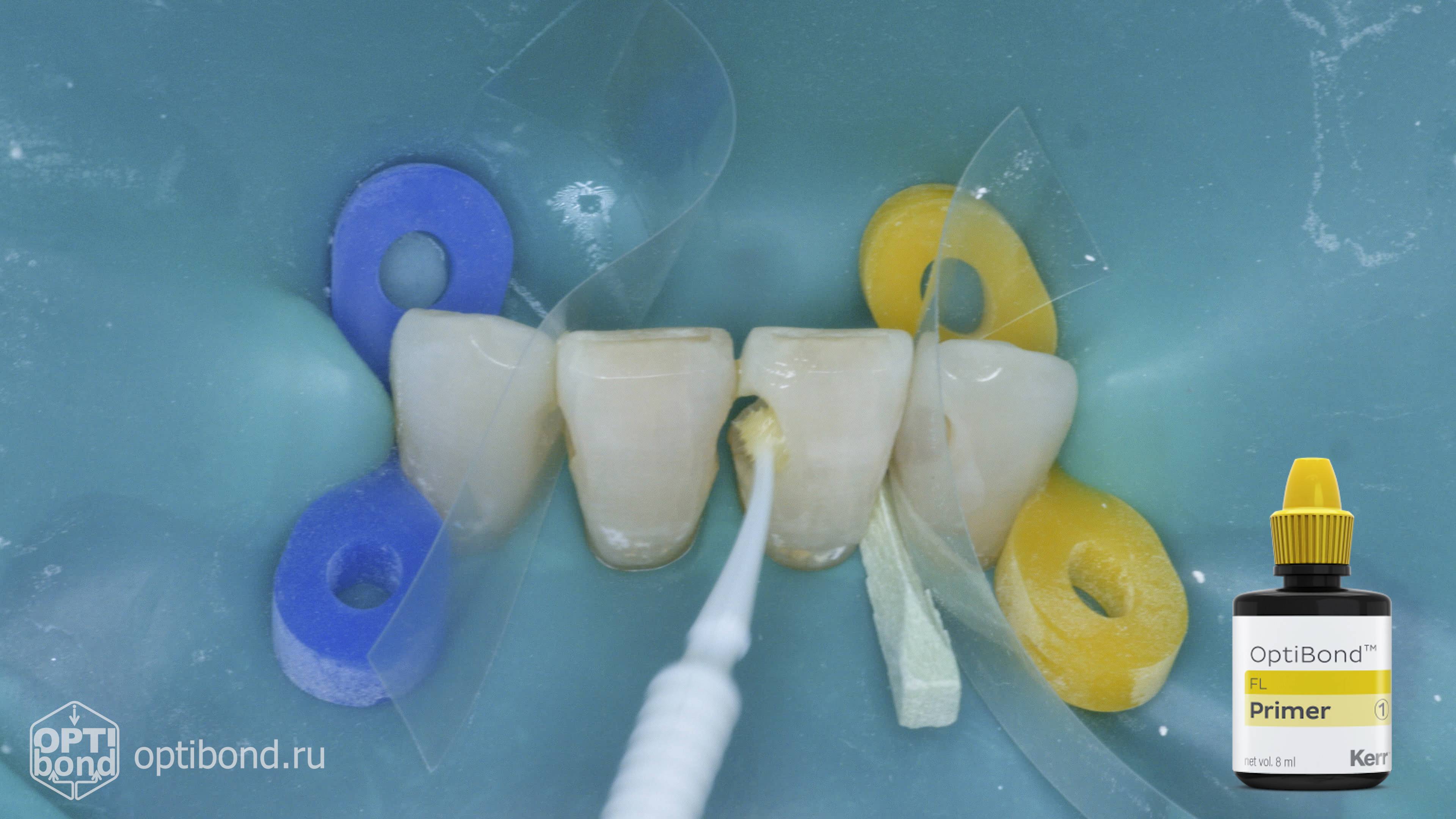#Optibond application to contact surfaces of tooth  32, 31, 41, 42 #rubberdamology