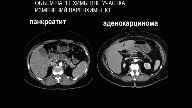 ЛД в онкологии. Часть 1 7. Лекция «Рак поджелудочной железы.(1)