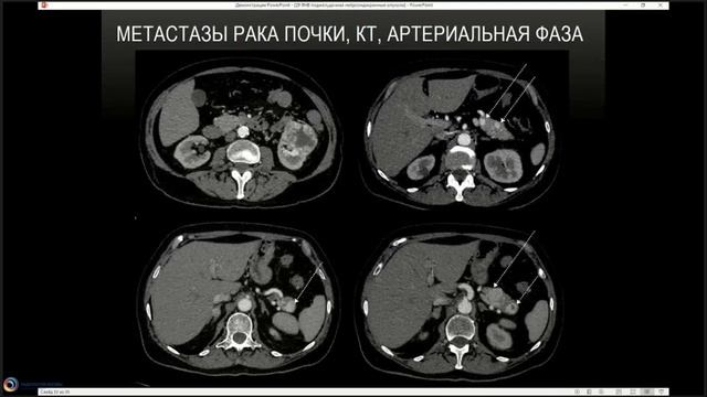 ЛД в онкологии. Часть 1 7. Лекция «Рак поджелудочной железы.(3)
