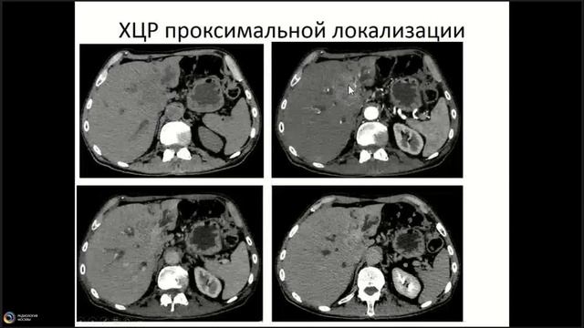 ЛД в онкологии. Часть 2 8. Лекция «Гепатоцеллюлярный рак. Оп(1)
