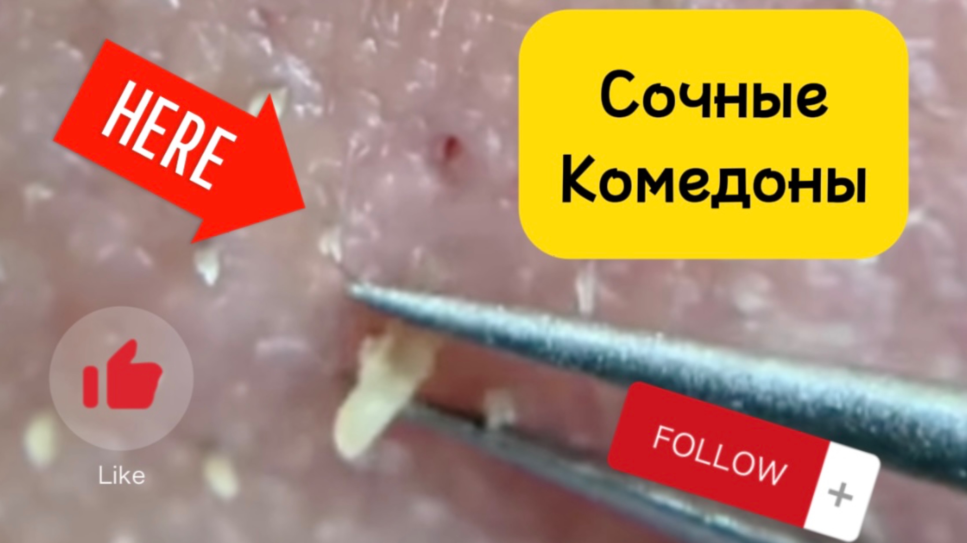 Очистка лица от угрей и акне.
Выдавливание прыщей. Удаление черных точек и комедонов.