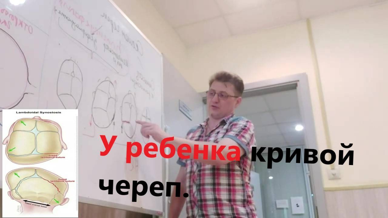 Деформация черепа у ребенка. Поможет ли остеопат?