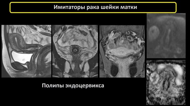 ЛД в онкологии. Часть 2 13. Лекция «Рак шейки матки». Лектор