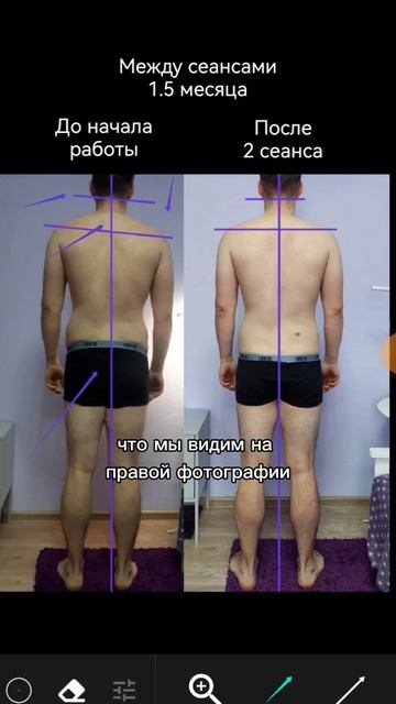 Результат моего клиента после двух сеансов в смешанной технике #массаж #здоровье #остеопластика