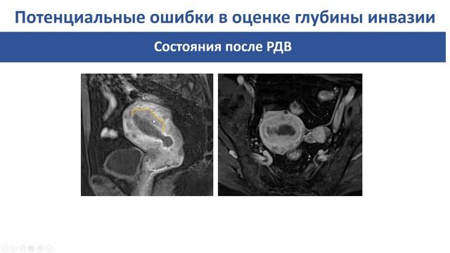 ЛД в онкологии. Часть 2 11. Лекция «Рак тела матки». Лектор (1)