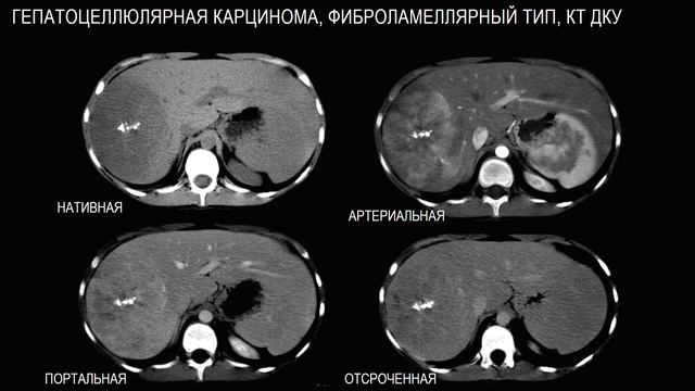 ЛД в онкологии. Часть 2 8. Лекция «Гепатоцеллюлярный рак. Оп
