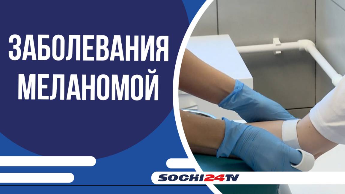 В Сочи выросло количество заболевших меланомой