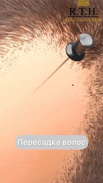 Чего вы еще не знаете о пересадки волос?