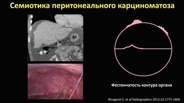 ЛД в онкологии. Часть 2 15. Лекция «Опухоли яичников». Лекто(1)