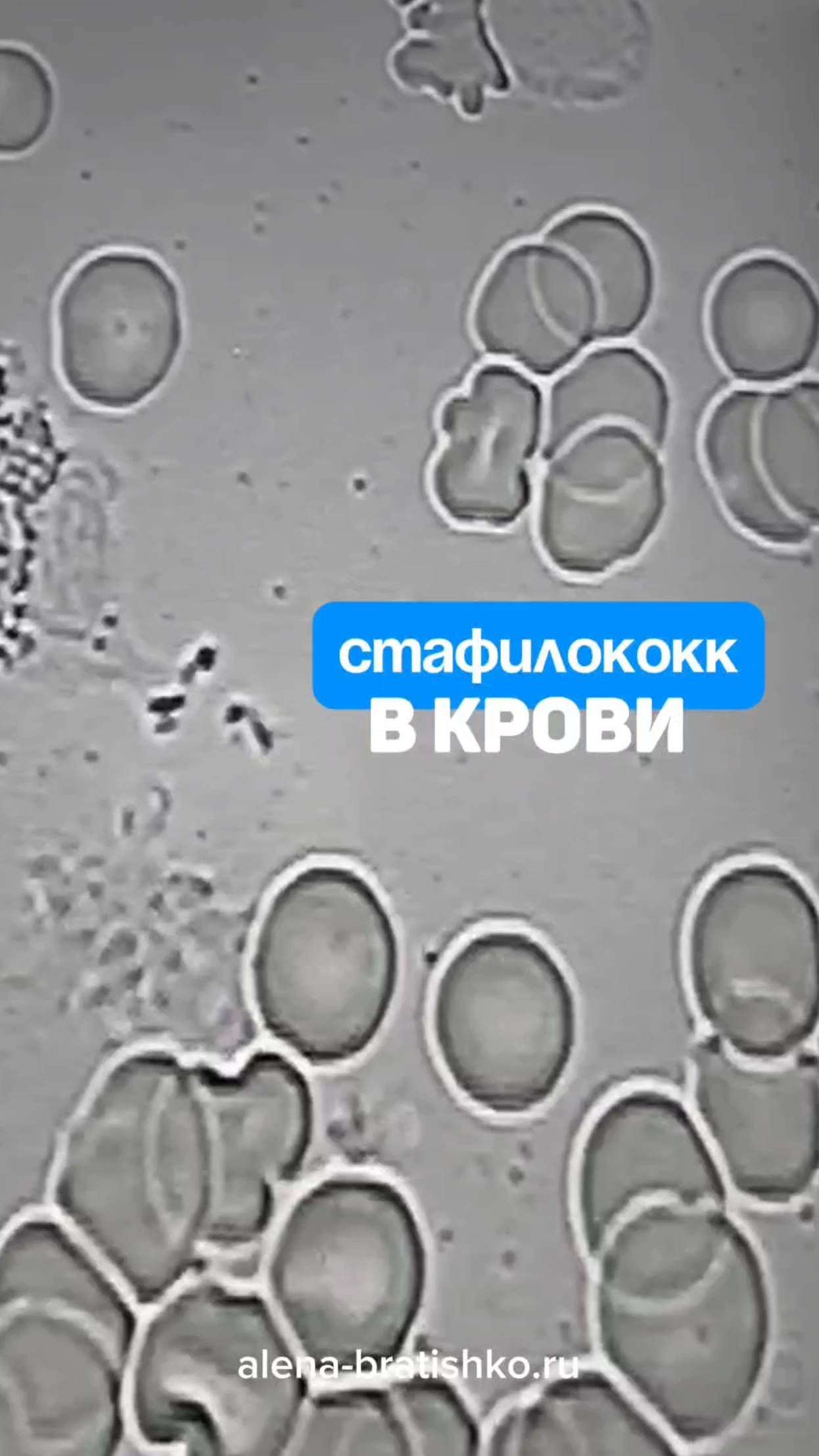 Стафилококк в крови под микроскопом. Семейный доктор Алена Братишко