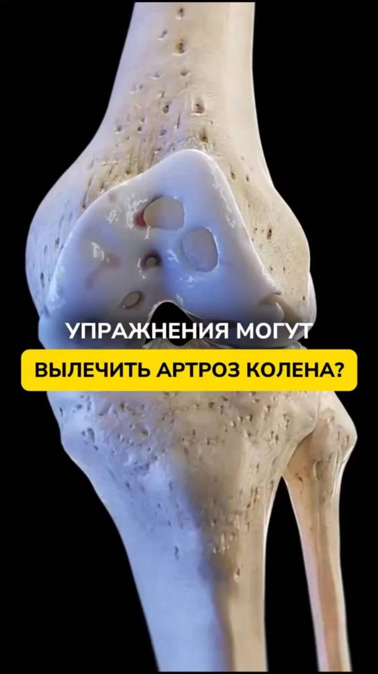 🤔КАК УПРАЖНЕНИЯ МОГУТ ПОМОЧЬ ПРИ АРТРОЗЕ?