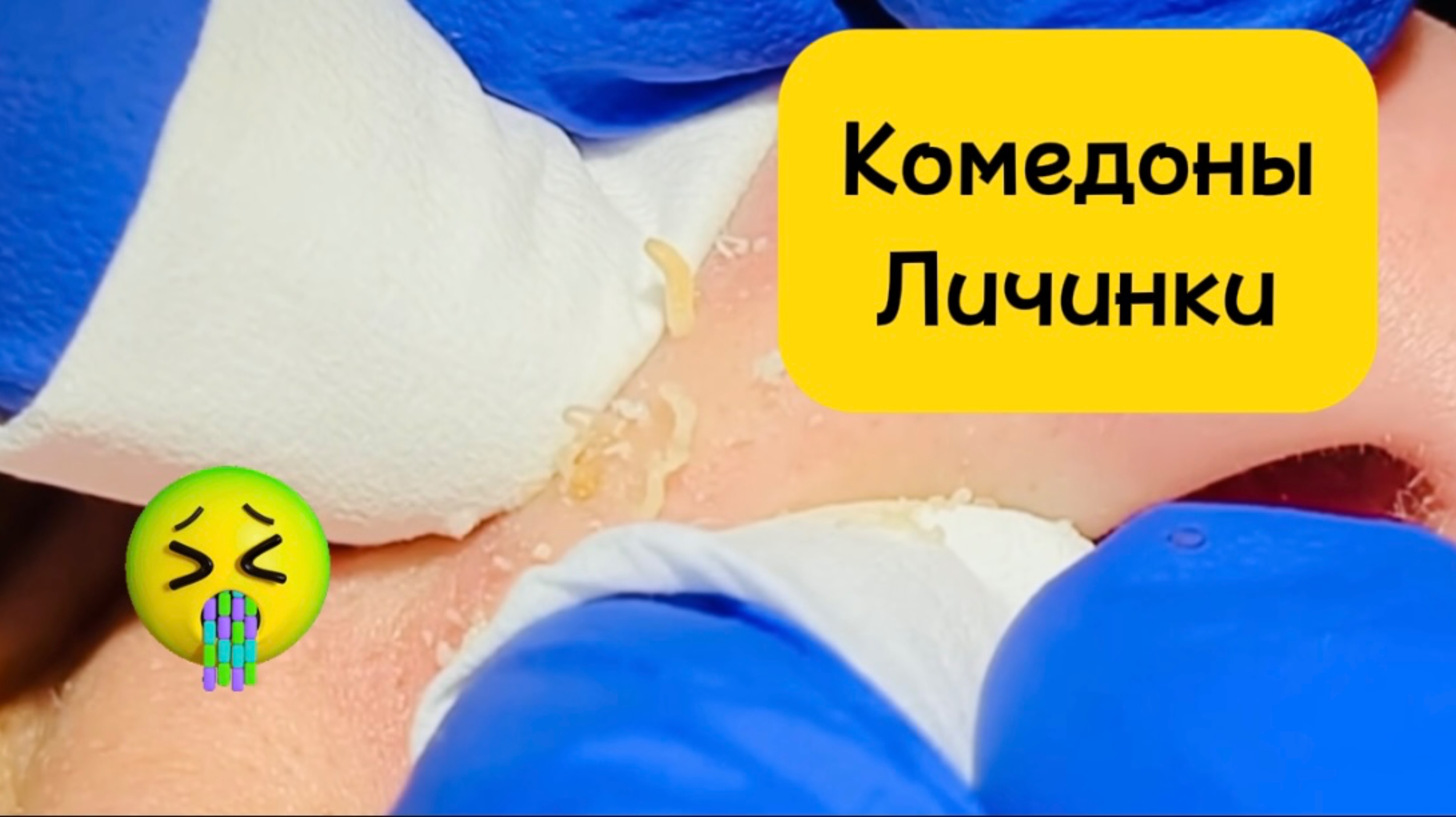 Очистка лица от угрей и акне.
Выдавливание прыщей. Удаление черных точек и комедонов.