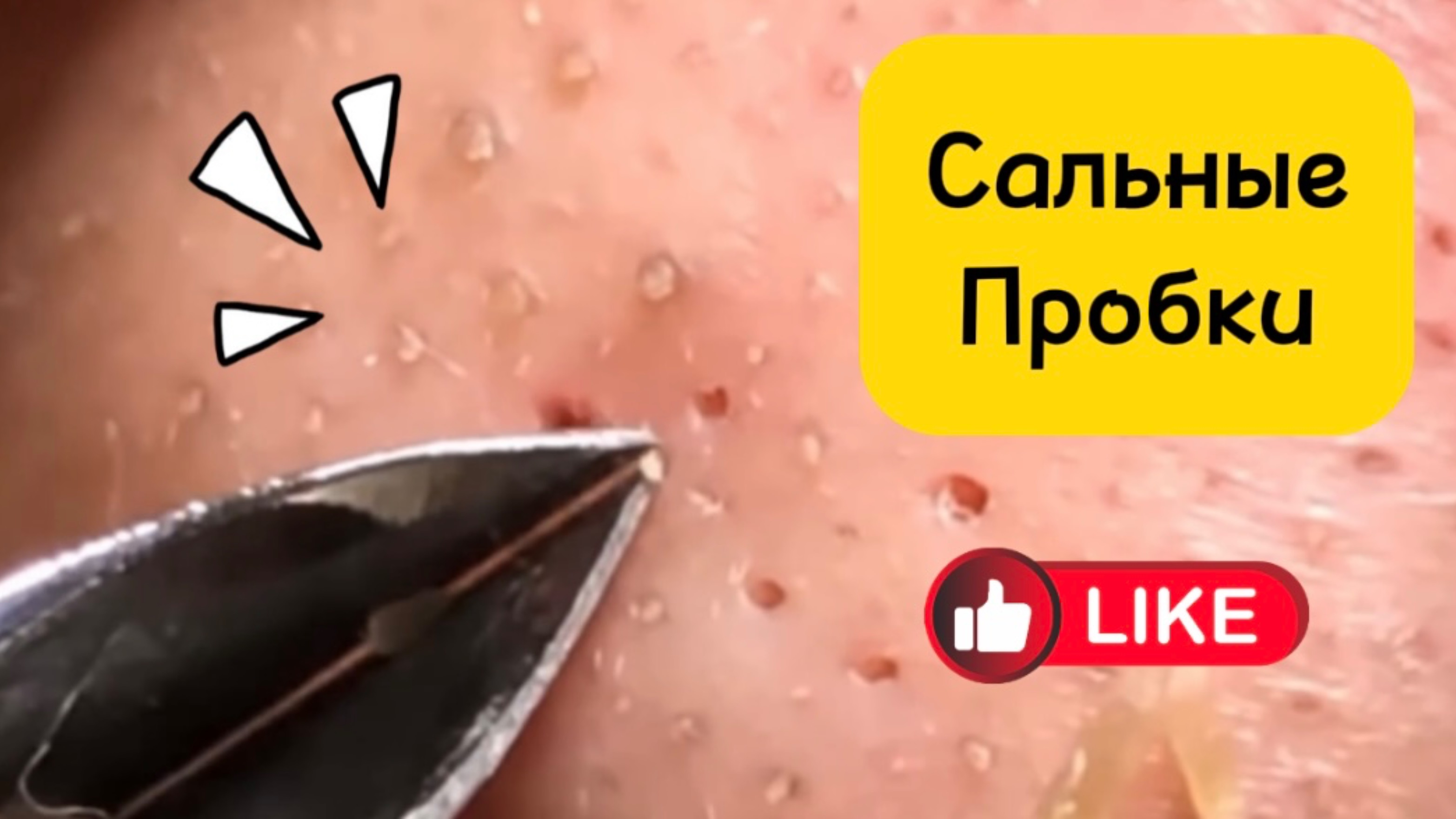 Очистка лица от угрей и акне.
Выдавливание прыщей. Удаление черных точек и комедонов.