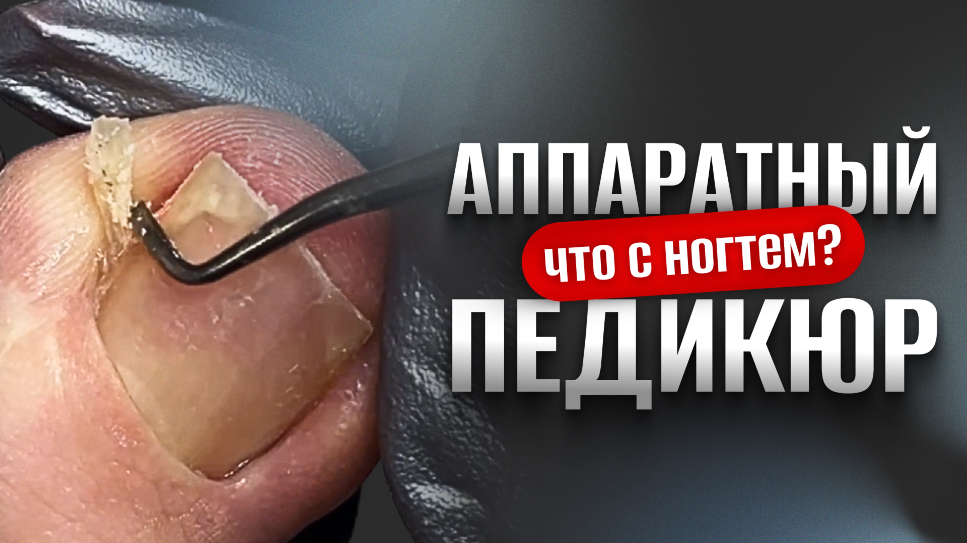 ХИРУРГ ИЗУРОДОВАЛ НОГОТЬ😱