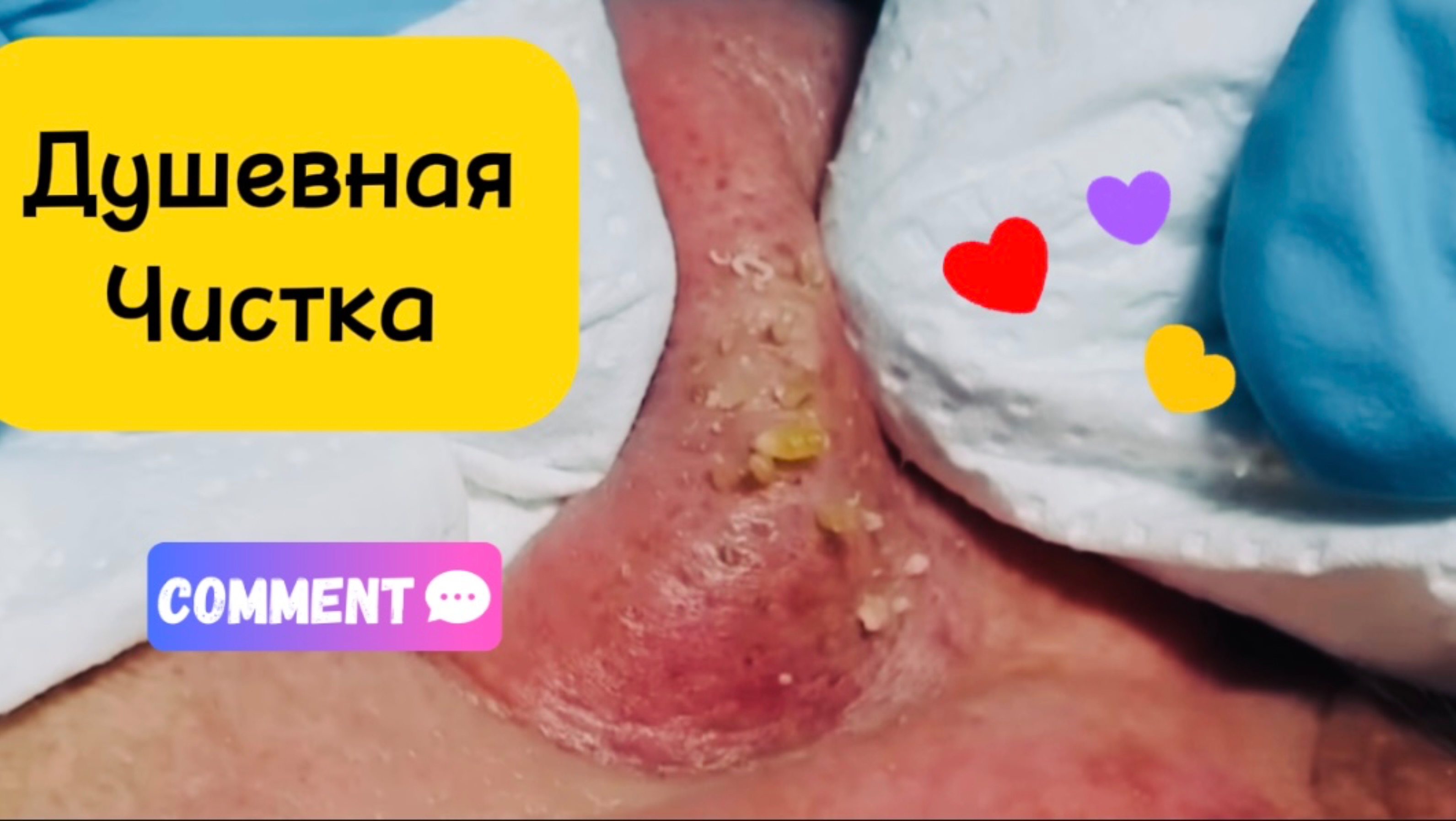 Очистка лица от угрей и акне.
Выдавливание прыщей. Удаление черных точек и комедонов.