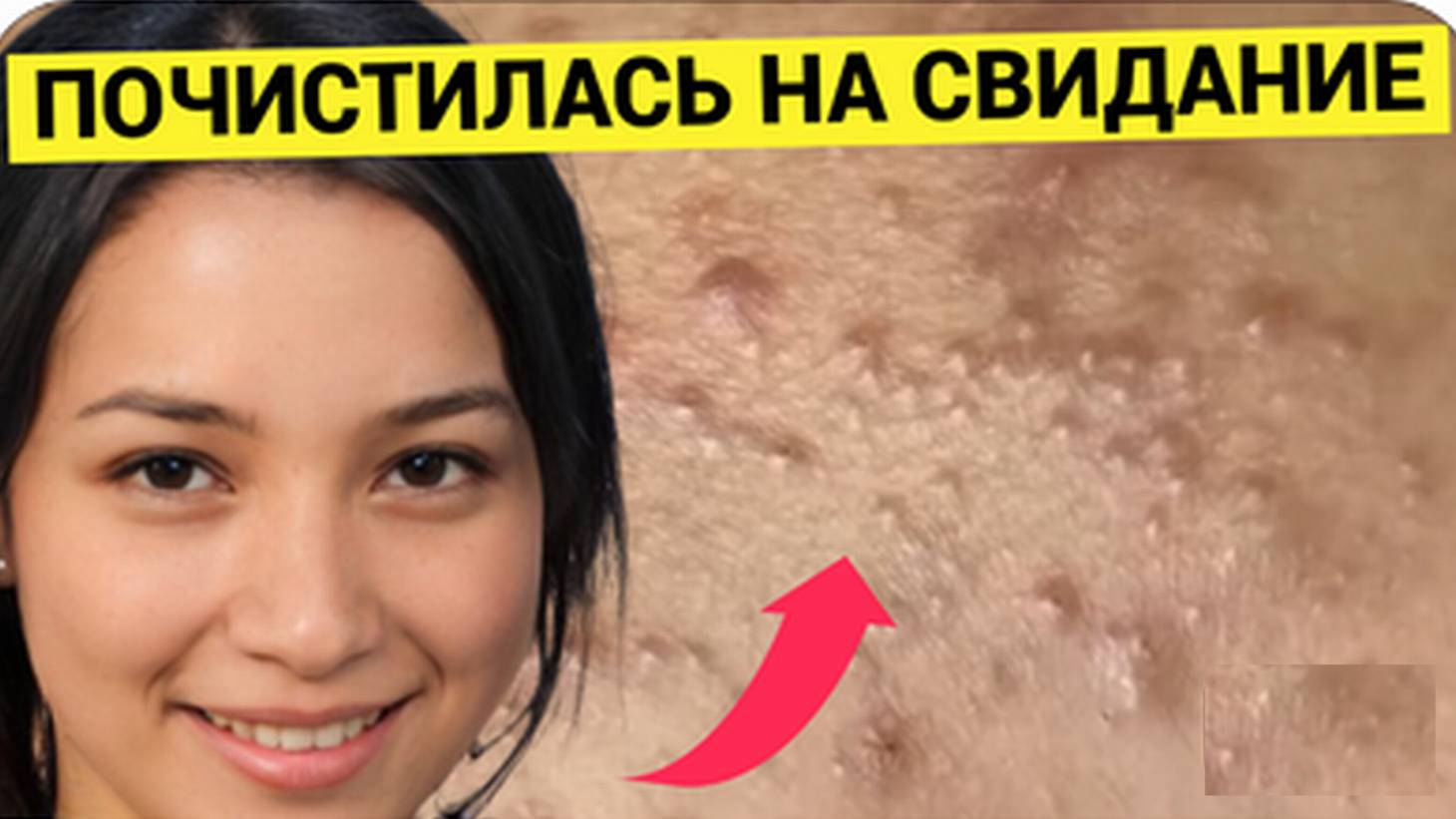 Решила Выдавить ПРЫЩИ Перед Свиданием. А Может и Перед Свадьбой. Хорошая Чистка Комедонов
