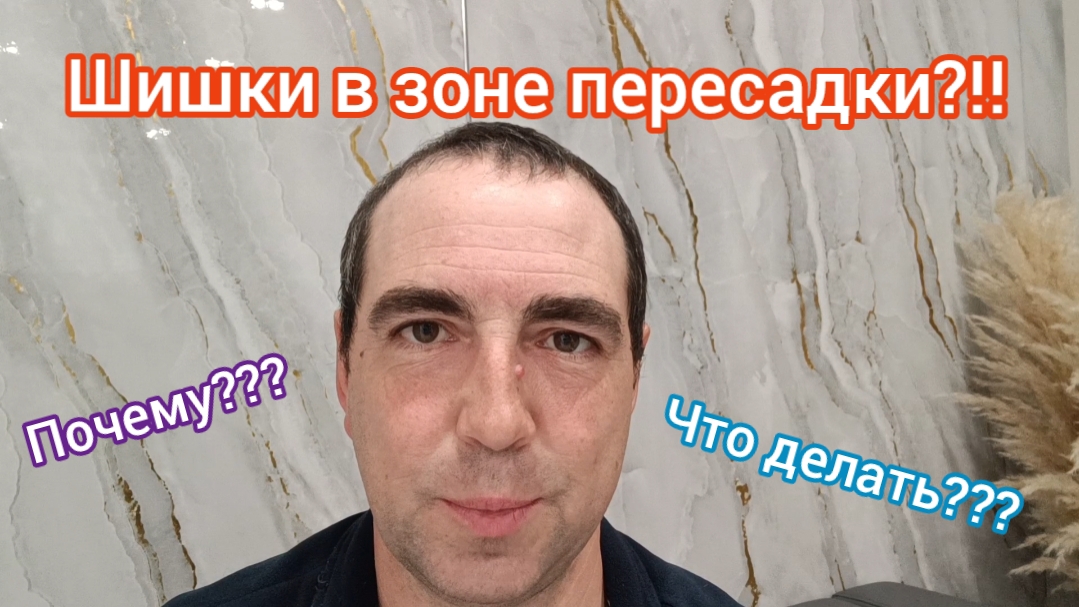 70 дней после пересадки волос. Что за шишки на голове?