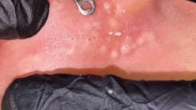 Механическая чистка лица