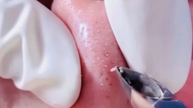 Механическая чистка лица