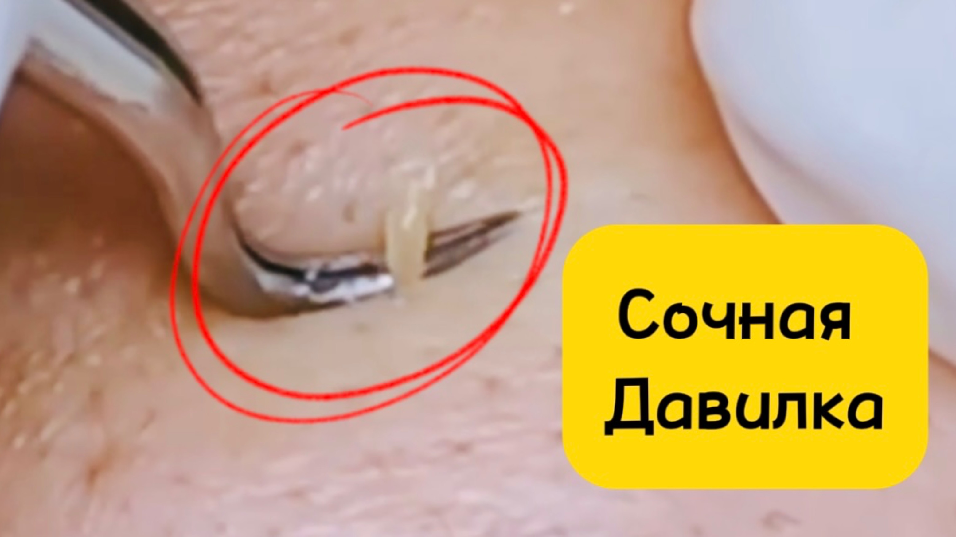Очистка лица от угрей и акне.
Выдавливание прыщей. Удаление черных точек и комедонов.