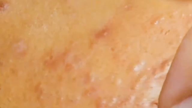 Механическая чистка лица