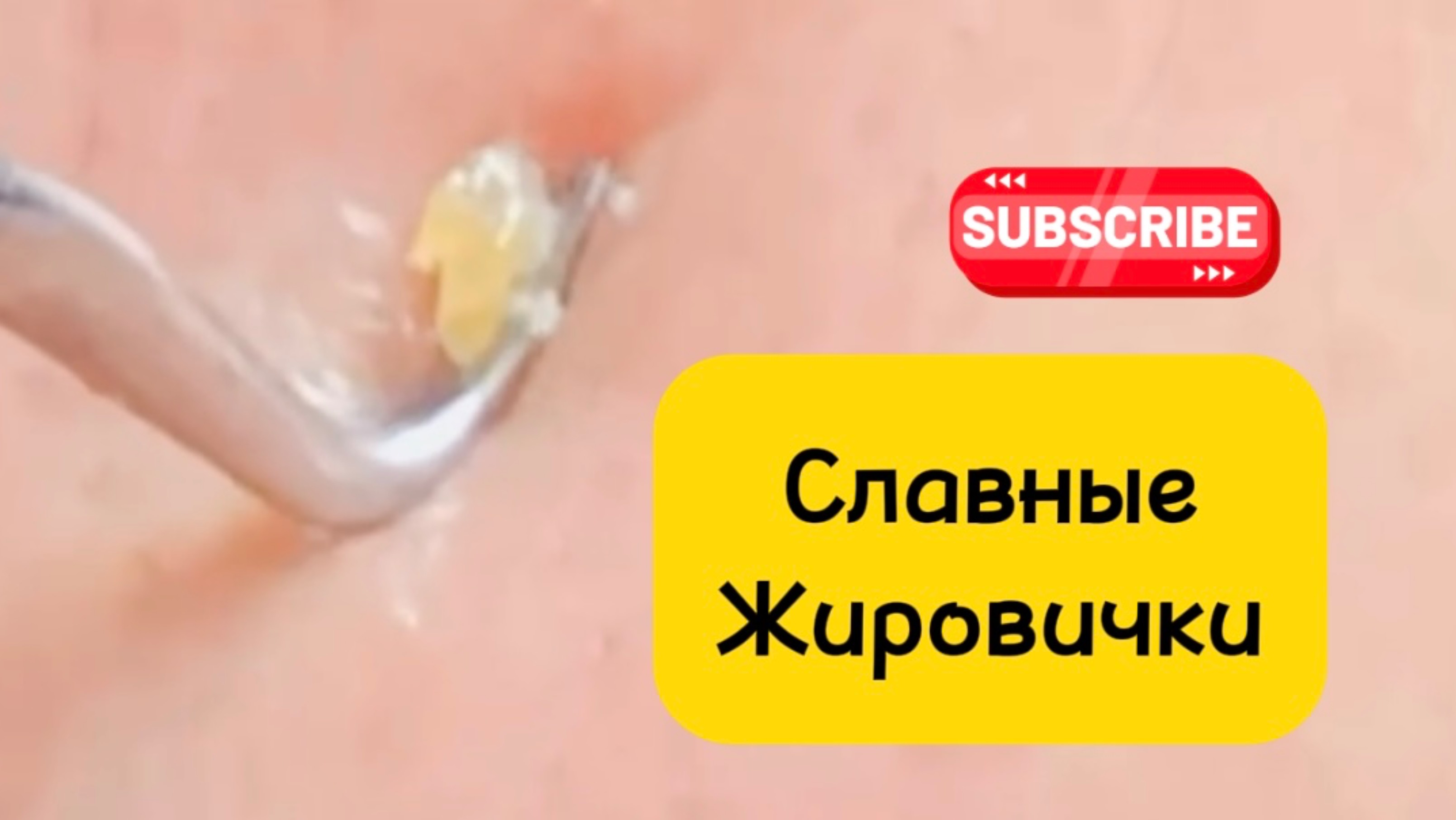 Очистка лица от угрей и акне.
Выдавливание прыщей. Удаление черных точек и комедонов.