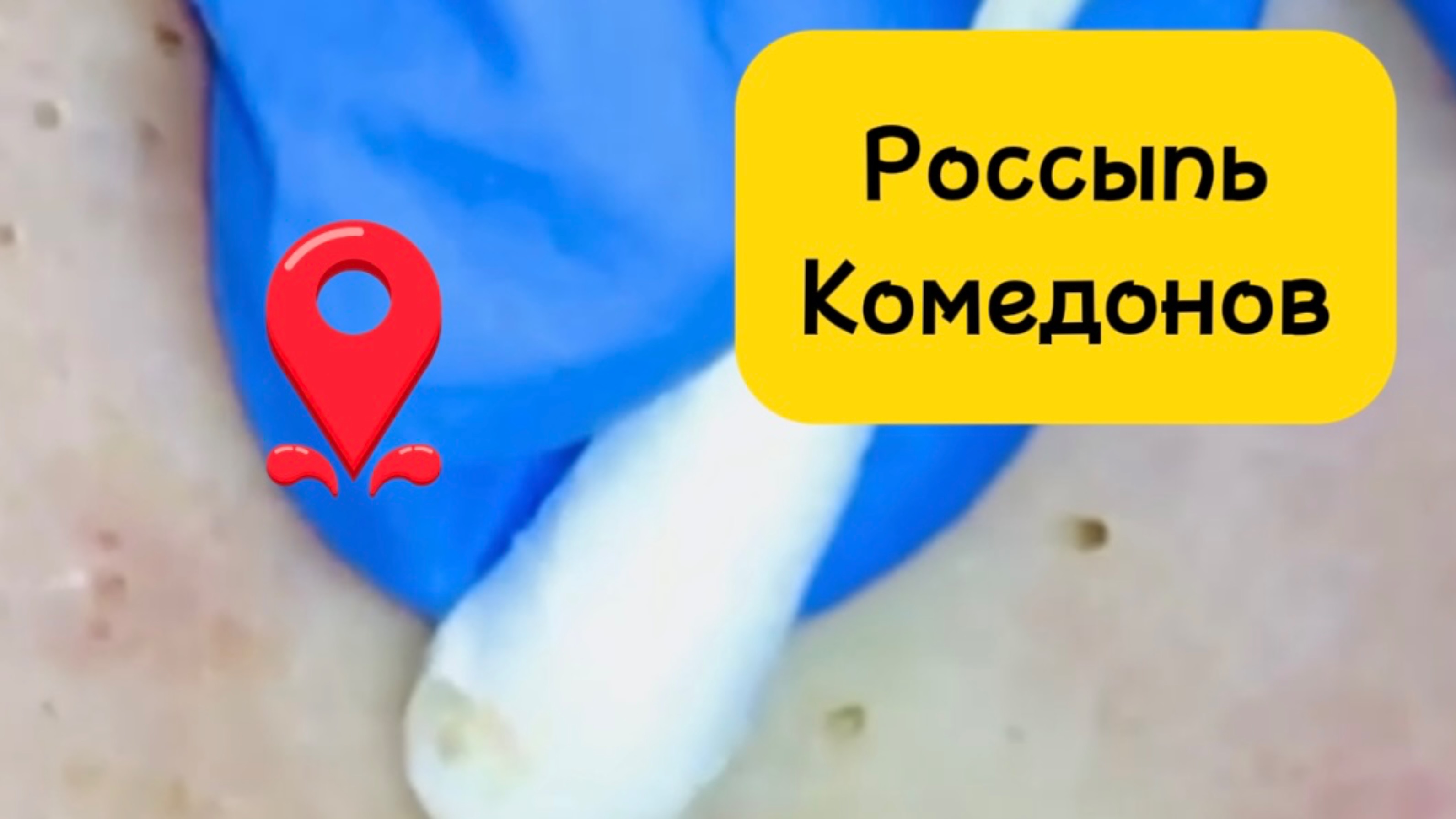 Очистка лица от угрей и акне.
Выдавливание прыщей. Удаление черных точек и комедонов