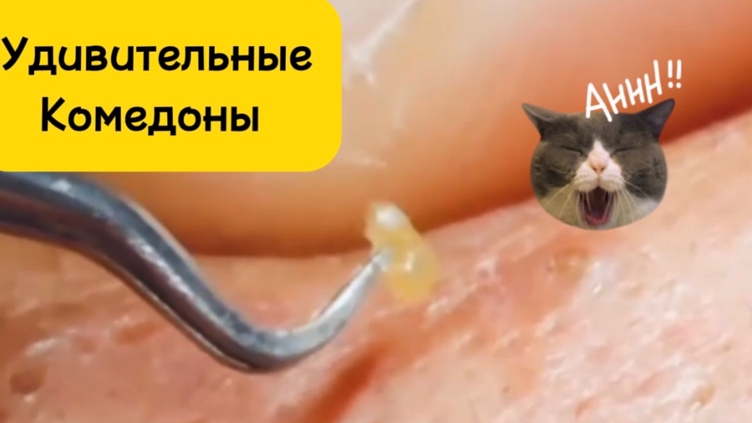Очистка лица от угрей и акне.
Выдавливание прыщей. Удаление черных точек и комедонов.