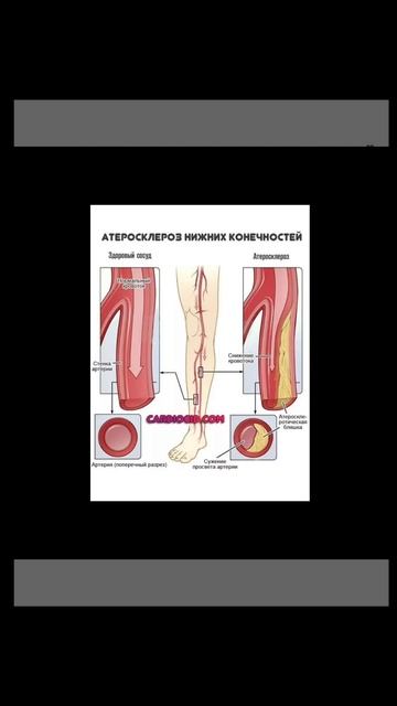Атеросклероз