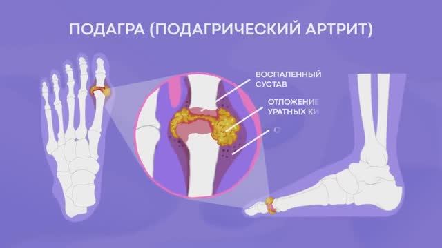 Кто бы мог подумать, что подагра боится обычной. Как избавиться от приступов под