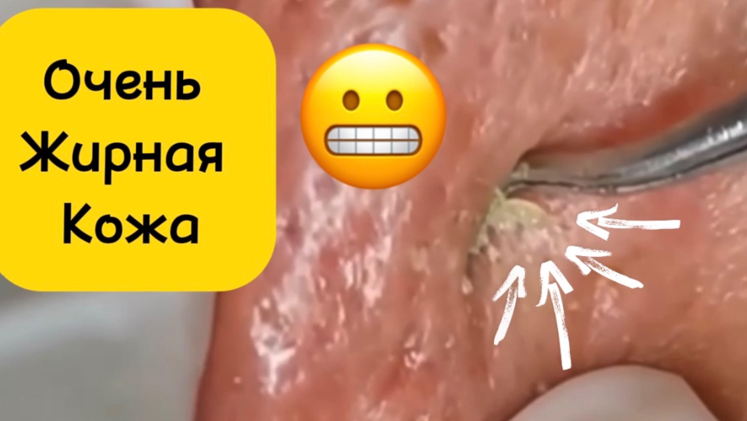Чистка лица от угрей и акне. Выдавливание прыщей. Удаление черных точек и комедонов.