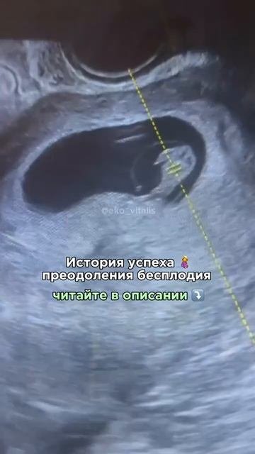 История успеха пациентки клиники Центр ЭКО Виталис Москва