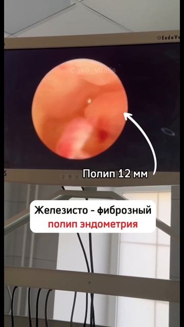 Клинический случай ЭКО